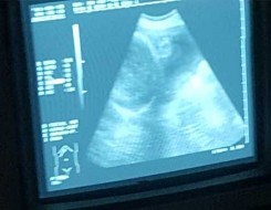 الدار البيضاء اليوم  - الولايات المتحدة تُطور اختبار جديد للحوامل يكشف الإضرابات الوراثية قبل ولادة الجنين